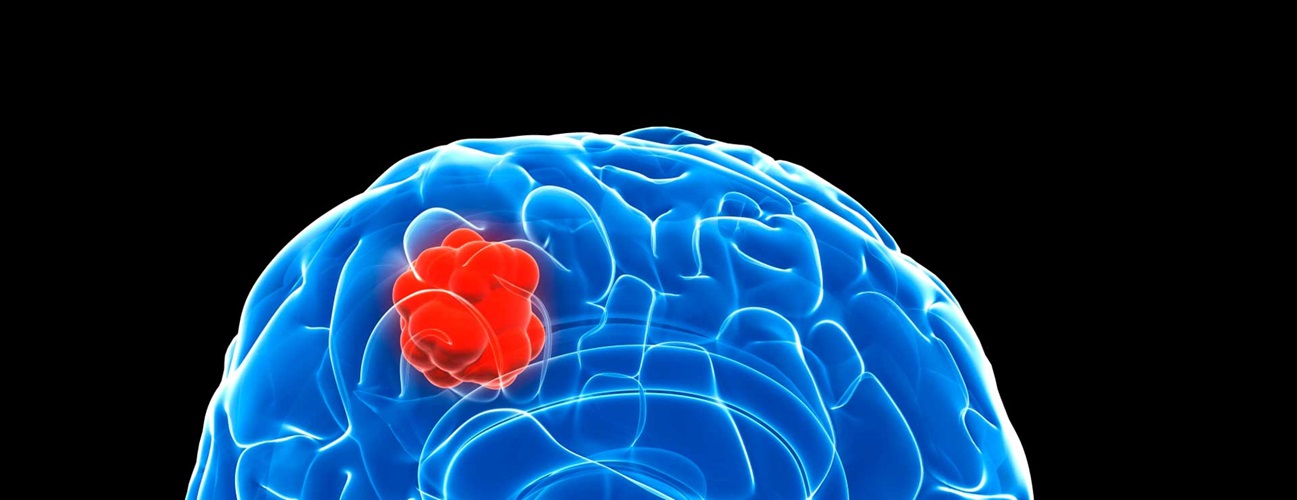 Glioblastoma Multiforme (GBM): Advancing Treatment for a Dangerous ...