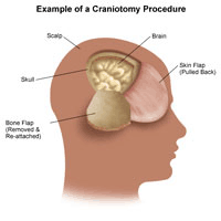 Illustration of an example of a craniotomy procedure