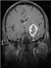 Scan of a grade II meningioma