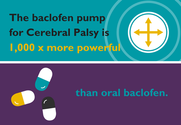 The baclofen pump for cerebral palsy is 1,000 times more powerful than oral baclofen.