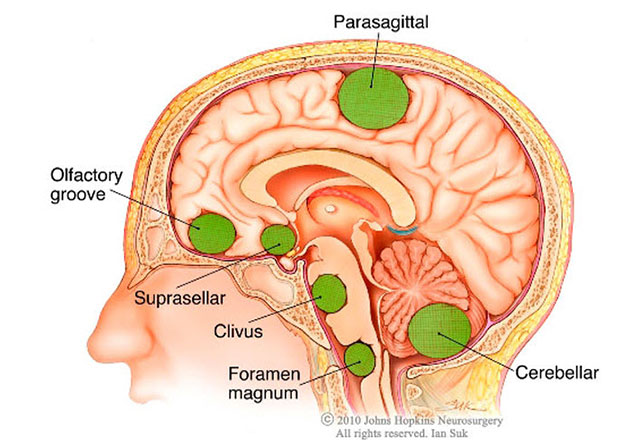 Areas where meningiomas most commonly form