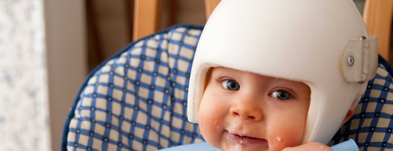 baby with a cranial correction helmet