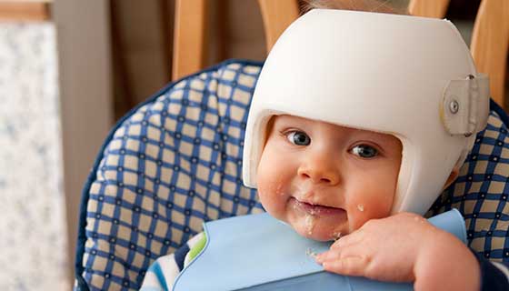 baby with a cranial correction helmet