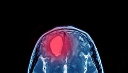 imaging of brain aneurysm
