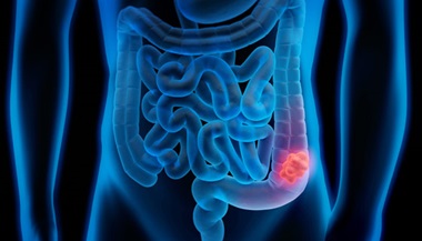 Illustration of colon cancer