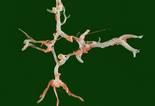 A berry aneurysm is shown in a cadaver specimen.