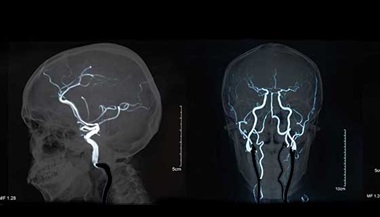 brain blood vessels seen on an angiogram