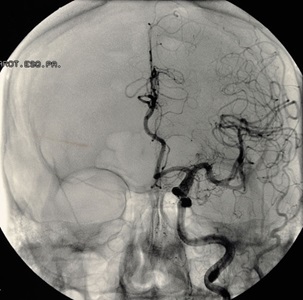 Angiogram of a brain aneurysm