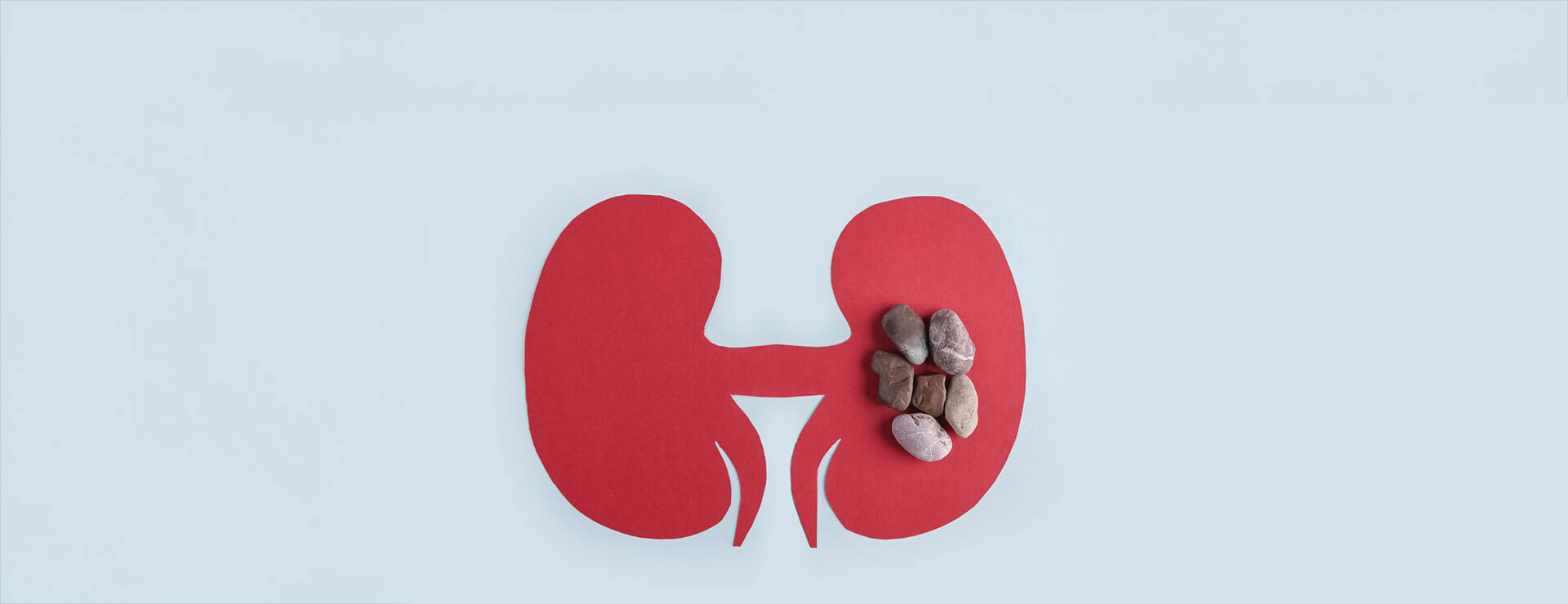 Rocks on top of an illustration of kidneys, representing kidney stones