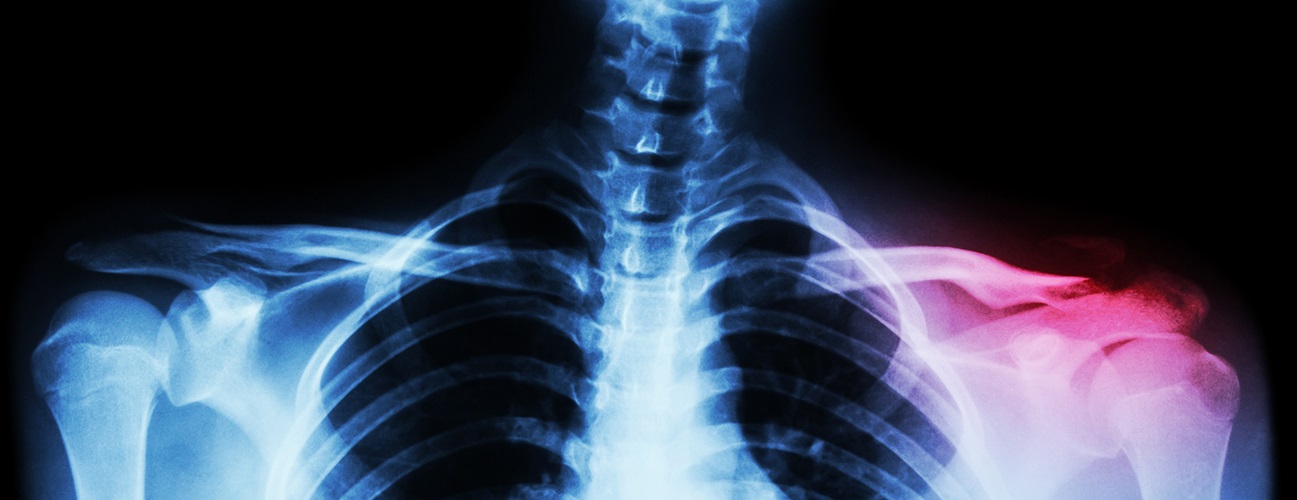 X-ray of clavicle fracture