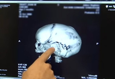 Scan of Craniosynostosis affecting a child's skull