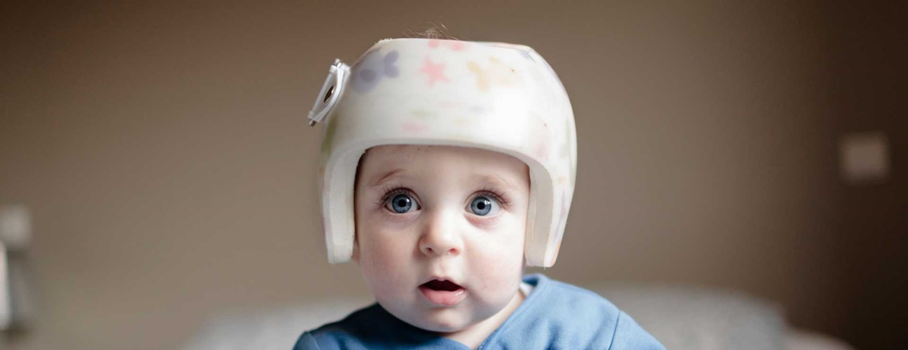 baby in helmet for plagycephaly
