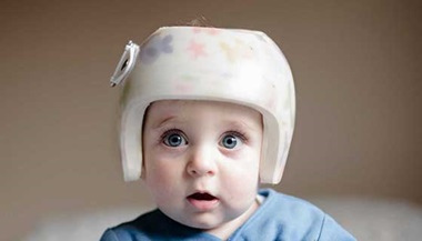 baby with helmet for plagycephaly