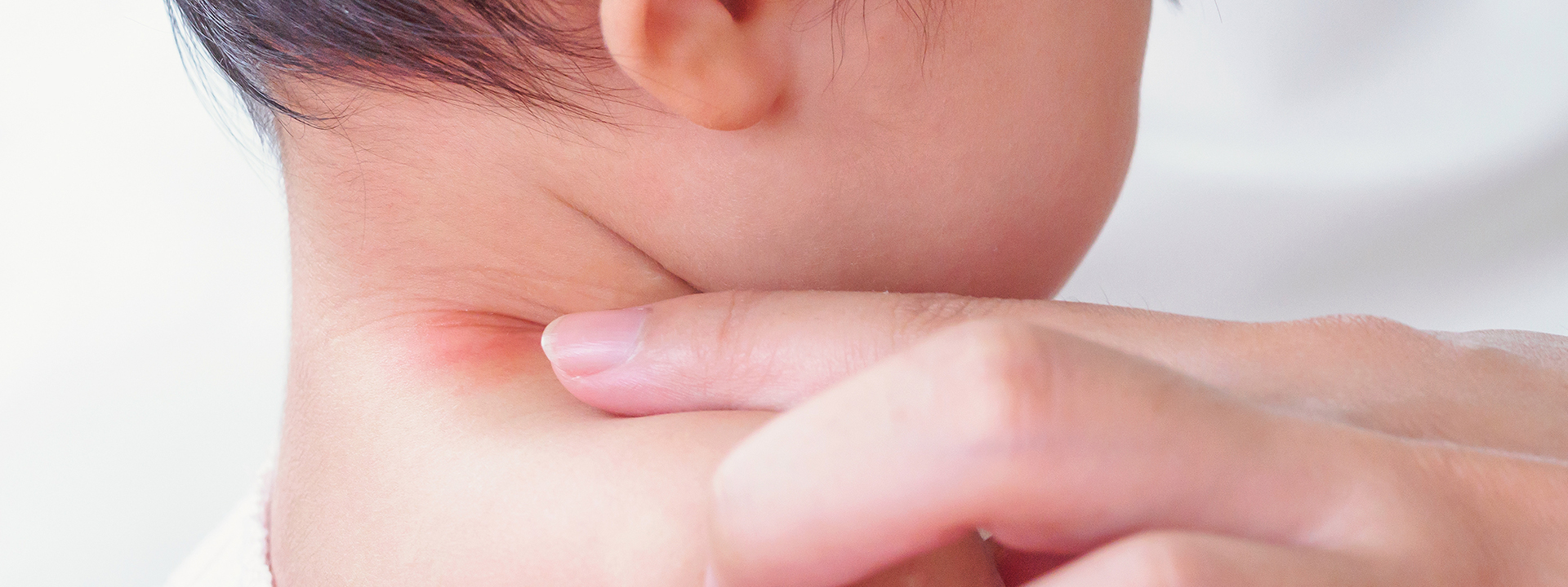 rash on child's skin