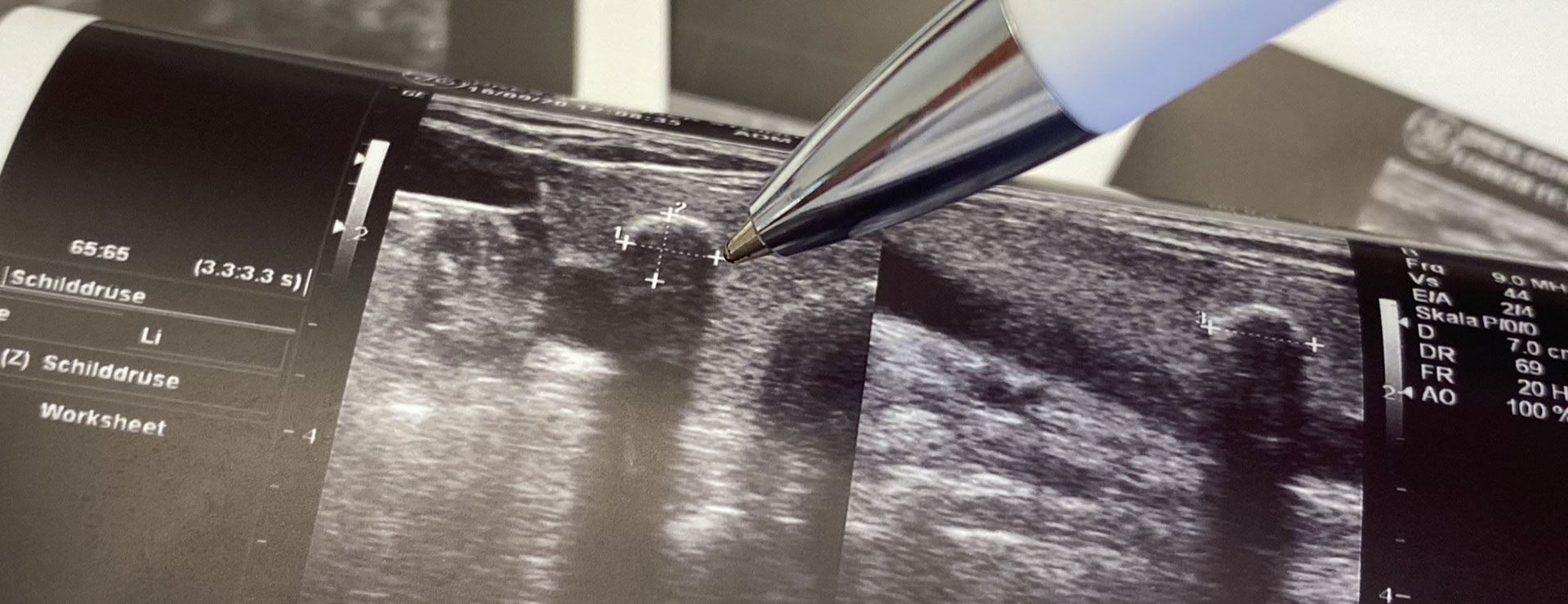 a pen points to a tumor on the thyroid in an ultrasound image