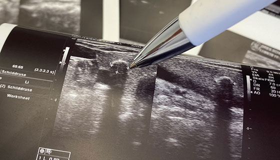 a pen points to a tumor on the thyroid in an ultrasound image