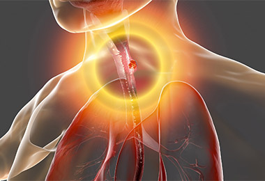 Esophageal cancer illustration. 