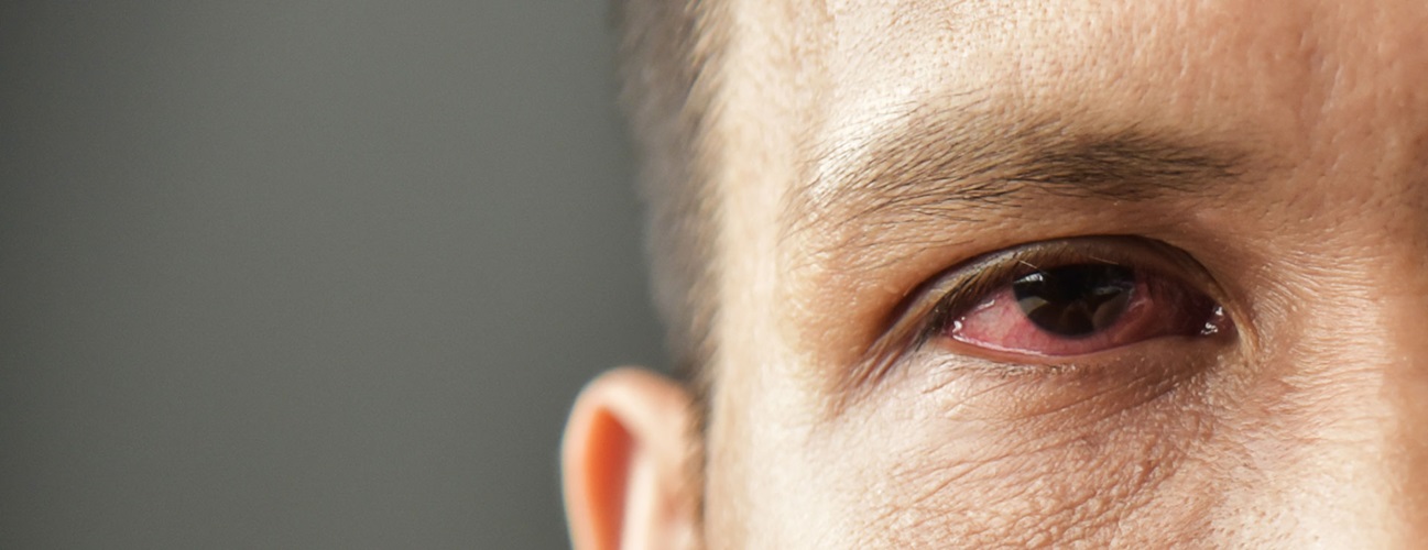 a man with redness in the eye
