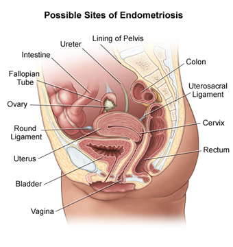 Graphic showing where endometriosis develops in female body