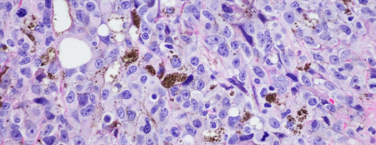 A micrograph of vulvar malignant melanoma.