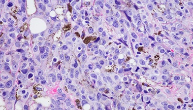 A micrograph of vulvar malignant melanoma.