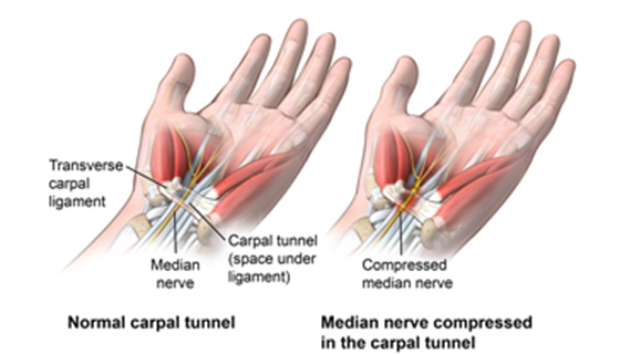 Carpal Tunnel Syndrome  Johns Hopkins Medicine