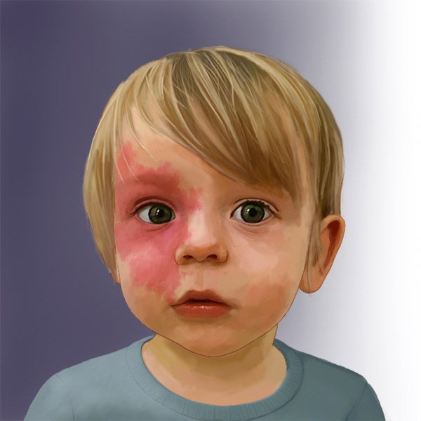 Child with Capillary malformation