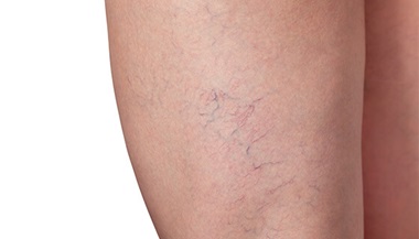 Varicose veins and capillary veins in the legs.