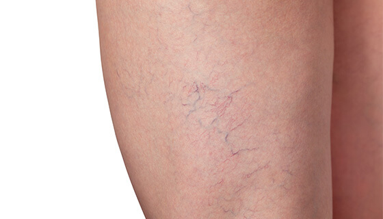 Fibromuscular Dysplasia (FMD) | Johns Hopkins Medicine