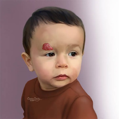 Illustration of a child with an infantile hemangioma above his eye. 