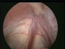 Laparoscopic view showing no inguinal hernia