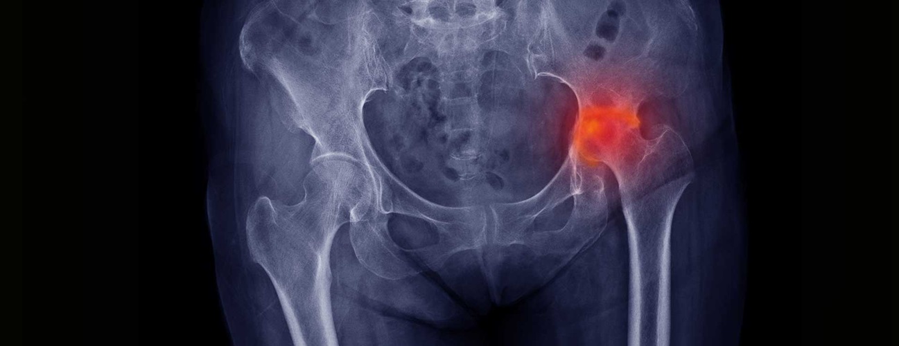 X-ray showing a hip with the hip joint highlighted.
