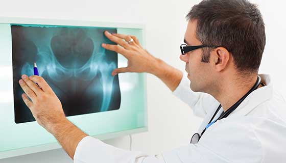 Doctor looking at  x-ray of a patient's hip.
