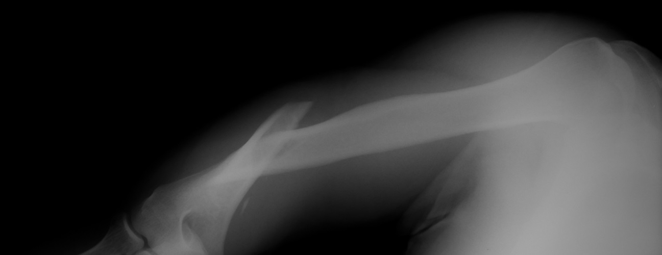 X-ray of a humerus fracture