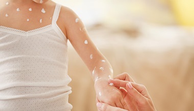 Chinelpocks Rash Shingles | Johns Hopkins Medicine