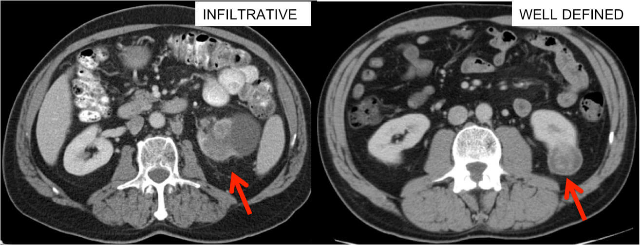 CT Scan showing a kidney tumor