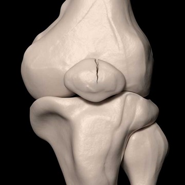 Digital illustration of a fracture on the kneecap
