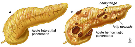 Comparison of healthy pancreas and one affected by acute pancreatitis, showing hemorrhaging
