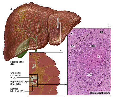 A: Cholangiocarcinoma within a cirrhotic liver; B: cross-section of tumor; C: histological imaging showing tumor cells surrounding normal hepatocytes. 