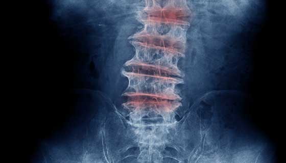 x-ray of spine with degenerative disease