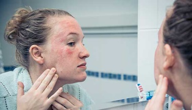 A young woman examines a facial rash in the mirror.
