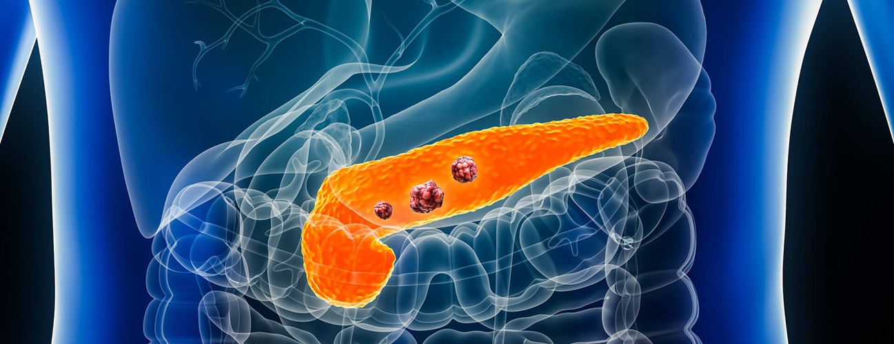 An illustration of pancreatic cancer in a male body.