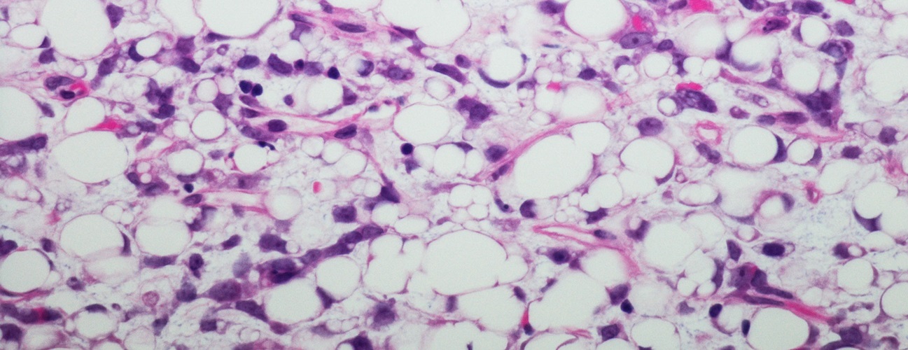 liposarcoma cells under a microscope