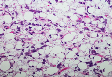 Sarcoma cells up close