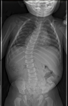X-ray before treatment of an infant’s spine who was diagnosed with infantile idiopathic scoliosis.