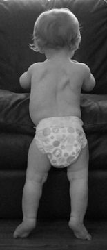 Asymmetry of the back is visible in this infant who was diagnosed with infantile idiopathic scoliosis.