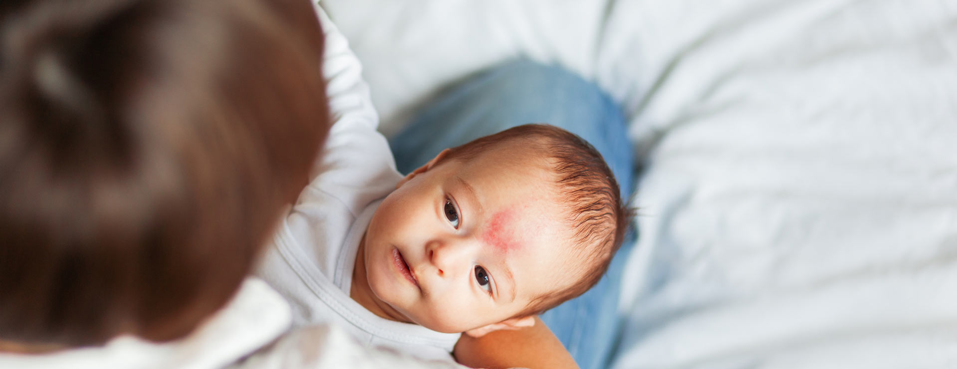 Infant with a birth mark on their forehead