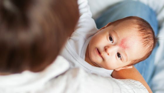 Infant with a birth mark on their forehead
