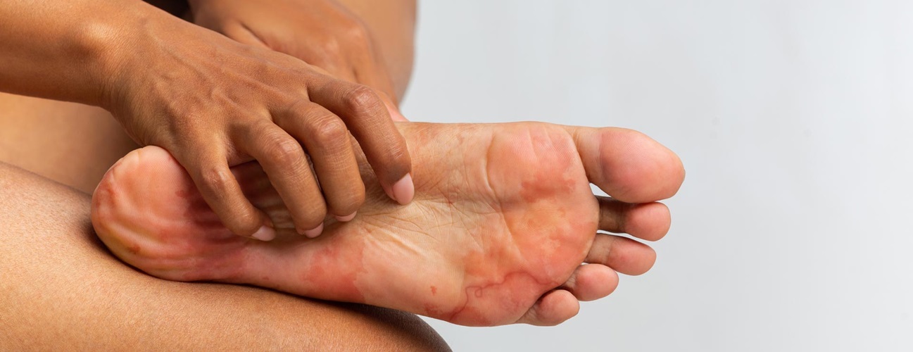 Pin Worm Rash