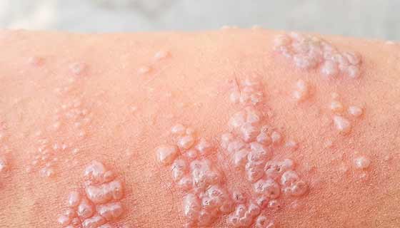 57-Year-Old Female With 2-Day History of Sore Bumps on Trunk